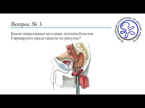 Вопрос № 3 Какая оперативная методика лечения болезни Гиршпрунга представлена на рисунке?