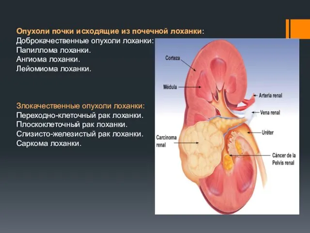 Опухоли почки исходящие из почечной лоханки: Доброкачественные опухоли лоханки: Папиллома лоханки.