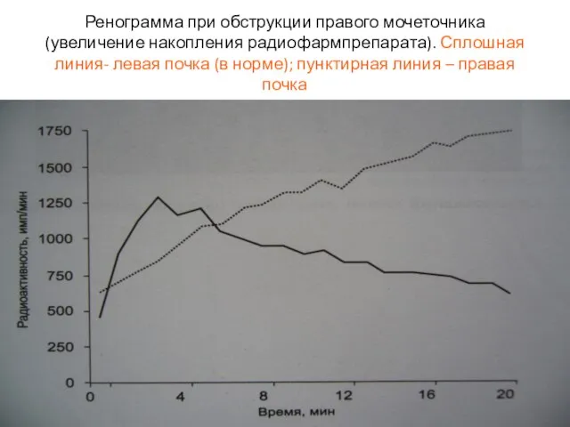 Ренограмма при обструкции правого мочеточника (увеличение накопления радиофармпрепарата). Сплошная линия- левая