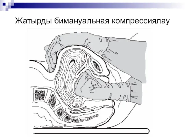 Жатырды бимануальная компрессиялау