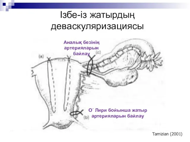 Ізбе-із жатырдың деваскуляризациясы Tamizian (2001) О´ Лири бойынша жатыр артерияларын байлау Аналық безінің артерияларын байлау