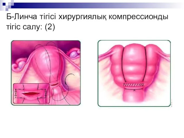 Б-Линча тігісі хирургиялық компрессионды тігіс салу: (2)