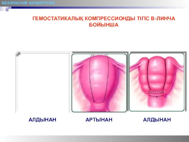 БЕЗОПАСНОЕ АКУШЕРСТВО ГЕМОСТАТИКАЛЫҚ КОМПРЕССИОНДЫ ТІГІС В-ЛИНЧА БОЙЫНША АЛДЫНАН АЛДЫНАН АРТЫНАН