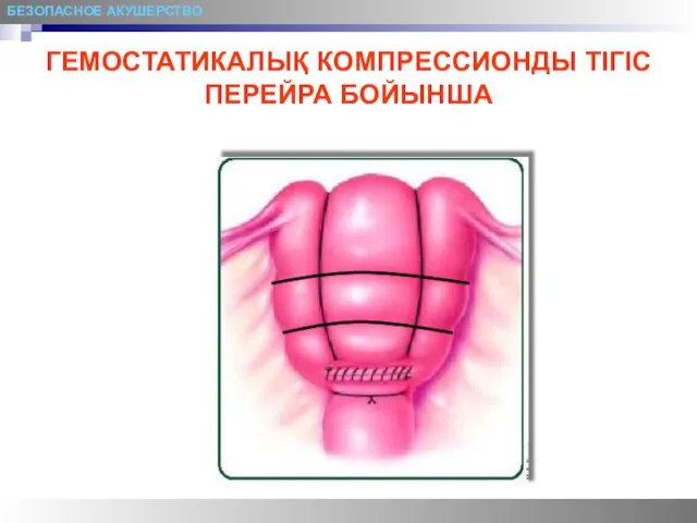 БЕЗОПАСНОЕ АКУШЕРСТВО ГЕМОСТАТИКАЛЫҚ КОМПРЕССИОНДЫ ТІГІС ПЕРЕЙРА БОЙЫНША