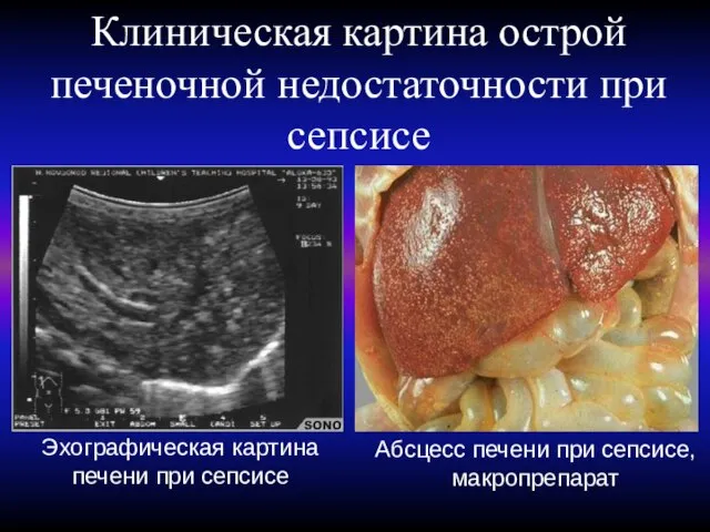 Клиническая картина острой печеночной недостаточности при сепсисе Абсцесс печени при сепсисе, макропрепарат