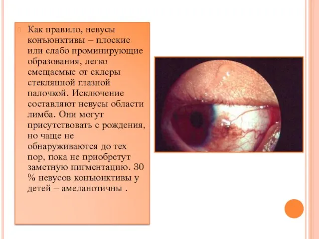 Как правило, невусы конъюнктивы – плоские или слабо проминирующие образования, легко