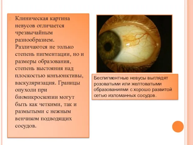 Клиническая картина невусов отличается чрезвычайным разнообразием. Различаются не только степень пигментации,