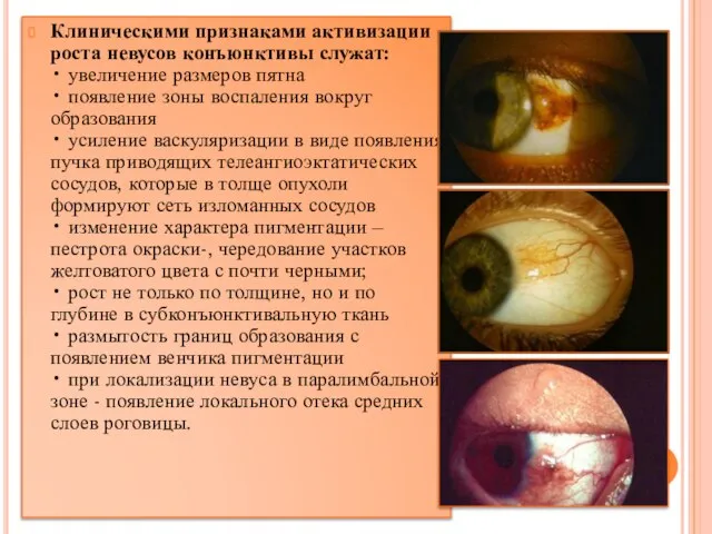 Клиническими признаками активизации роста невусов конъюнктивы служат: • увеличение размеров пятна