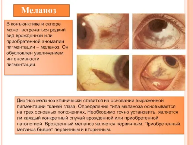 Меланоз В конъюнктиве и склере может встречаться редкий вид врожденной или