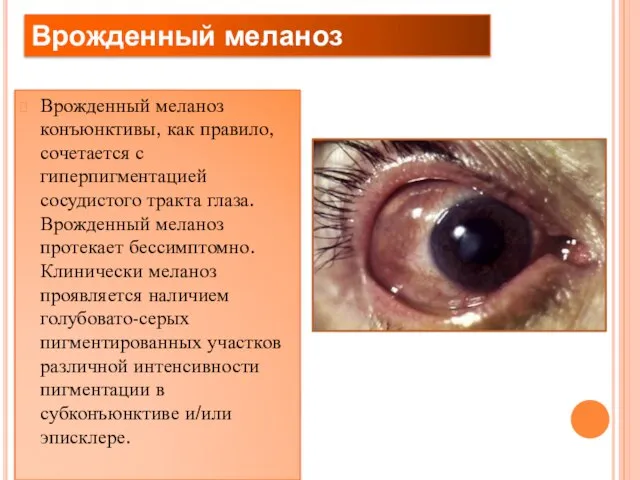 Врожденный меланоз конъюнктивы, как правило, сочетается с гиперпигментацией сосудистого тракта глаза.