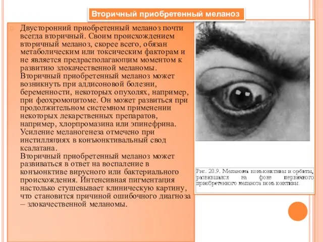 Двусторонний приобретенный меланоз почти всегда вторичный. Своим происхождением вторичный меланоз, скорее