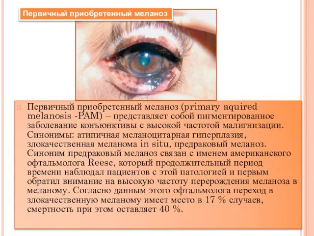 Первичный приобретенный меланоз (primary aquired melanosis -PAM) – представляет собой пигментированное