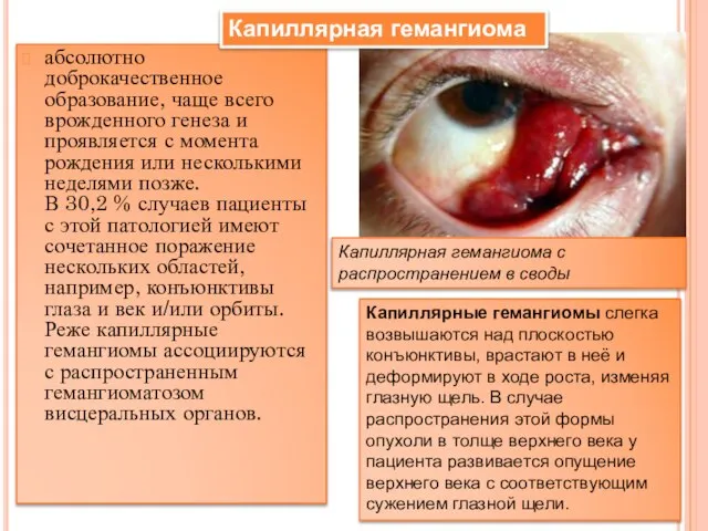 абсолютно доброкачественное образование, чаще всего врожденного генеза и проявляется с момента