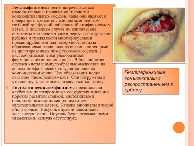 Гемлимфангиомы редко встречаются как самостоятельное проявление патологии конъюнктивальных сосудов, чаще они