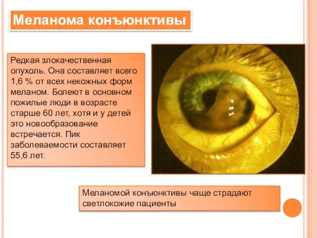 Меланома конъюнктивы Редкая злокачественная опухоль. Она составляет всего 1,6 % от