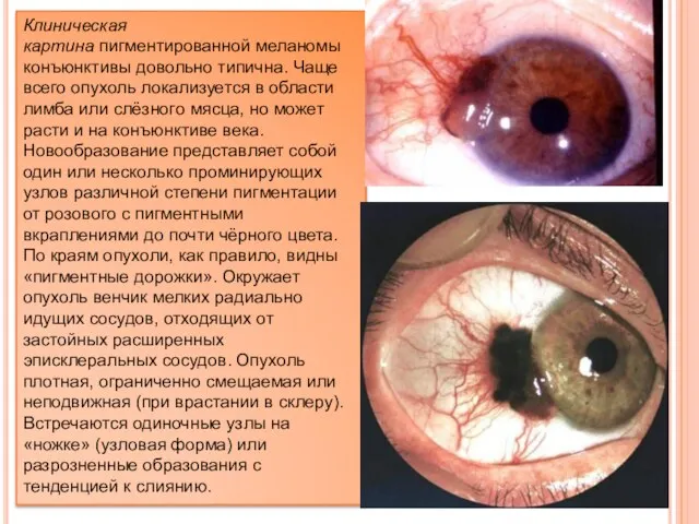 Клиническая картина пигментированной меланомы конъюнктивы довольно типична. Чаще всего опухоль локализуется