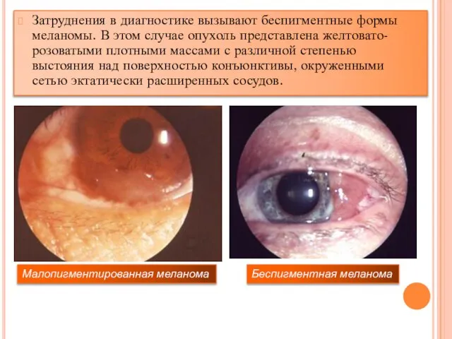 Затруднения в диагностике вызывают беспигментные формы меланомы. В этом случае опухоль