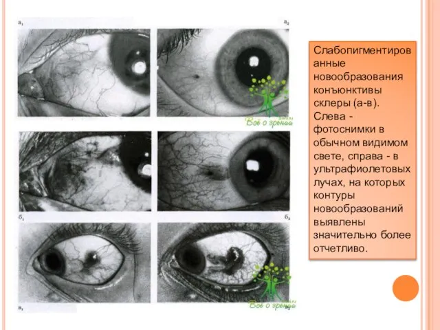 Слабопигментированные новообразования конъюнктивы склеры (а-в). Слева - фотоснимки в обычном видимом