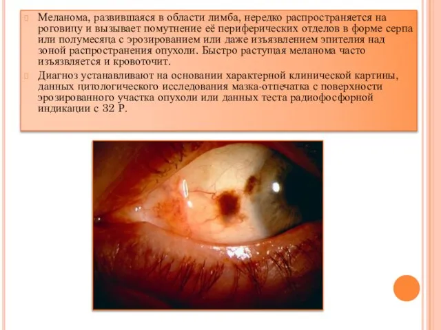 Меланома, развившаяся в области лимба, нередко распространяется на роговицу и вызывает