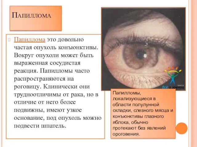 Папиллома Папиллома это довольно частая опухоль конъюнктивы. Вокруг опухоли может быть