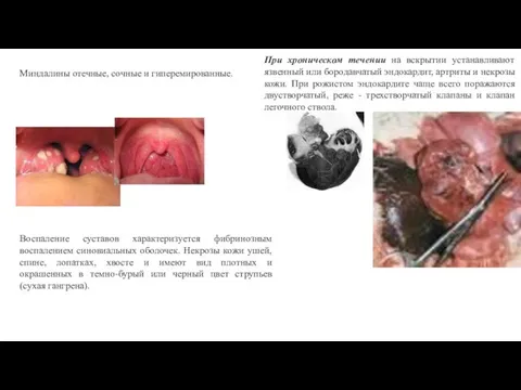 Миндалины отечные, сочные и гиперемированные. При хроническом течении на вскрытии устанавливают