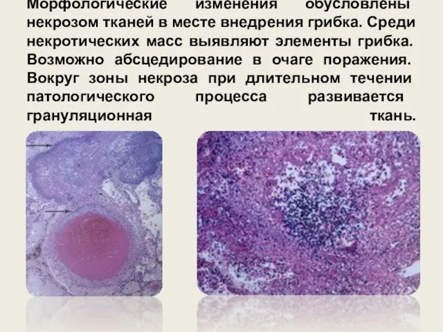 Морфологические изменения обусловлены некрозом тканей в месте внедрения грибка. Среди некротических