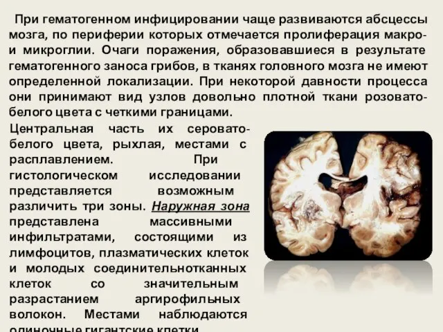 При гематогенном инфицировании чаще развиваются абсцессы мозга, по периферии которых отмечается