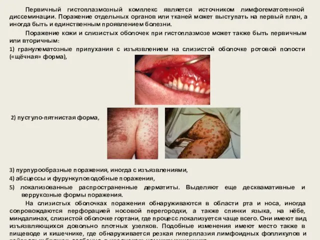 Первичный гистоплазмозный комплекс является источником лимфогематогенной диссеминации. Поражение отдельных органов или