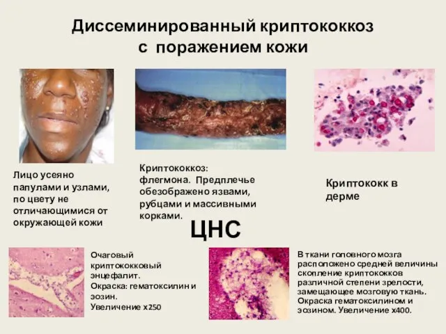 Диссеминированный криптококкоз с поражением кожи Лицо усеяно папулами и узлами, по