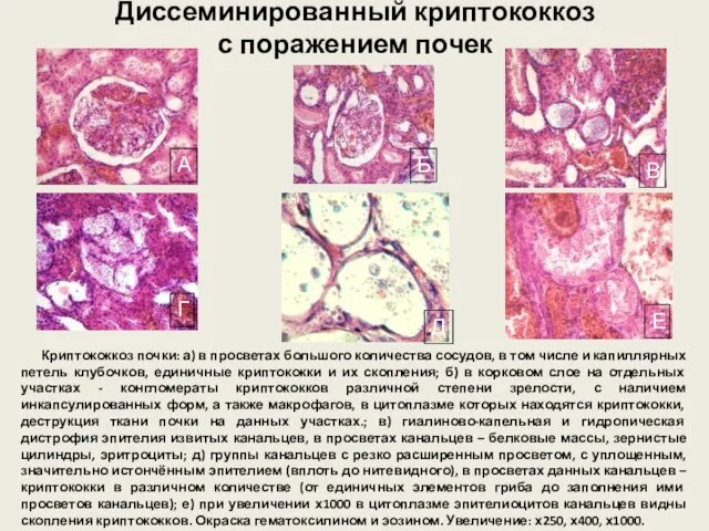 Диссеминированный криптококкоз с поражением почек Криптококкоз почки: а) в просветах большого