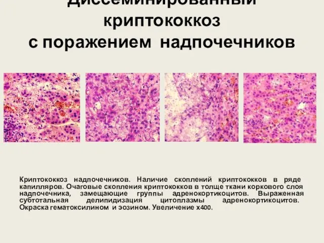 Диссеминированный криптококкоз с поражением надпочечников Криптококкоз надпочечников. Наличие скоплений криптококков в