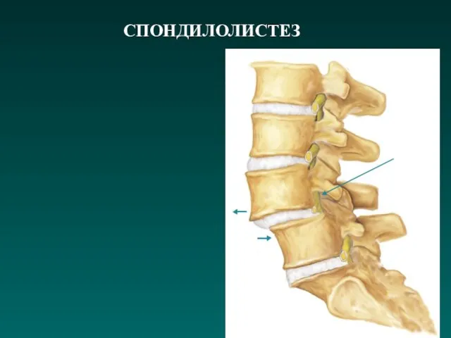 СПОНДИЛОЛИСТЕЗ