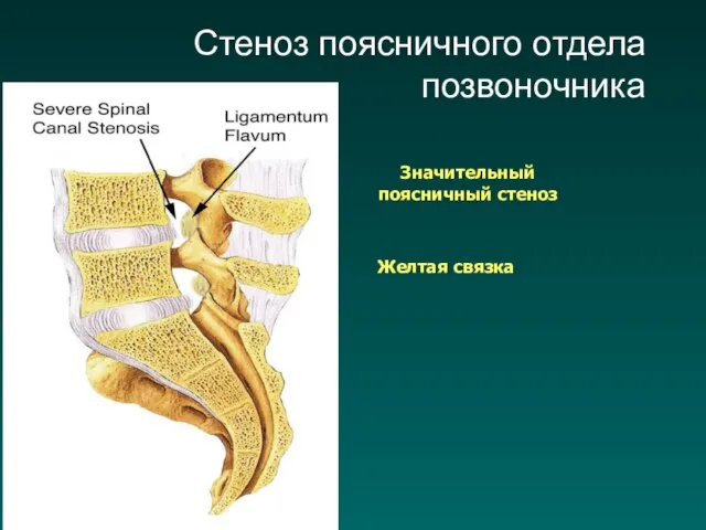 Значительный поясничный стеноз Желтая связка Стеноз поясничного отдела позвоночника