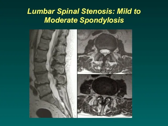 Lumbar Spinal Stenosis: Mild to Moderate Spondylosis