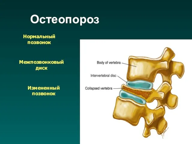 Нормальный позвонок Межпозвонковый диск Измененный позвонок Остеопороз
