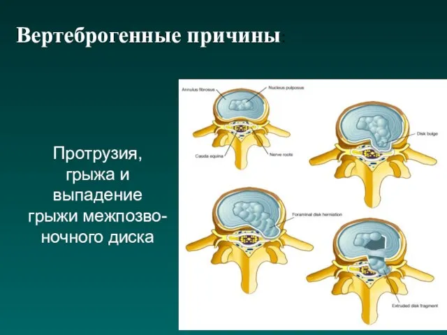 Вертеброгенные причины: Протрузия, грыжа и выпадение грыжи межпозво-ночного диска