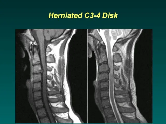 Herniated C3-4 Disk