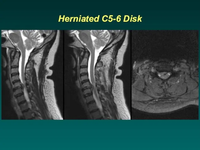 Herniated C5-6 Disk