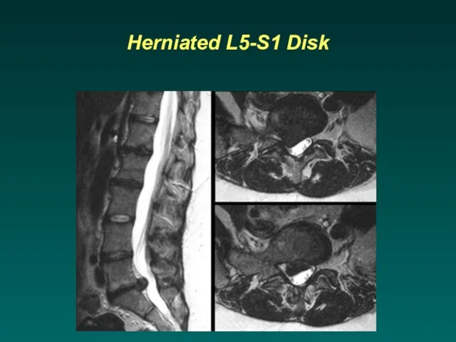 Herniated L5-S1 Disk