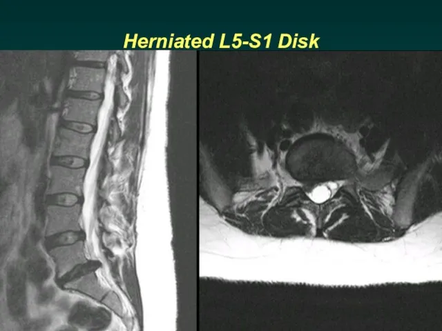 Herniated L5-S1 Disk