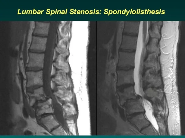Lumbar Spinal Stenosis: Spondylolisthesis