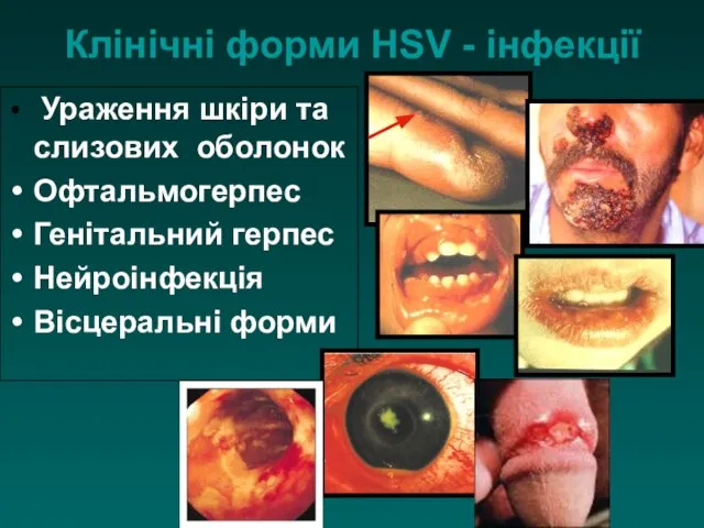 Клінічні форми HSV - інфекції Ураження шкіри та слизових оболонок Офтальмогерпес Генітальний герпес Нейроінфекція Вісцеральні форми