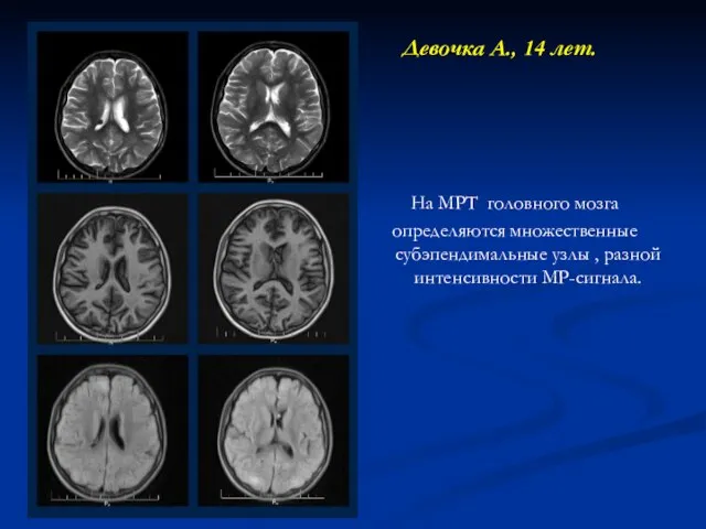 Девочка А., 14 лет. На МРТ головного мозга определяются множественные субэпендимальные узлы , разной интенсивности МР-сигнала.