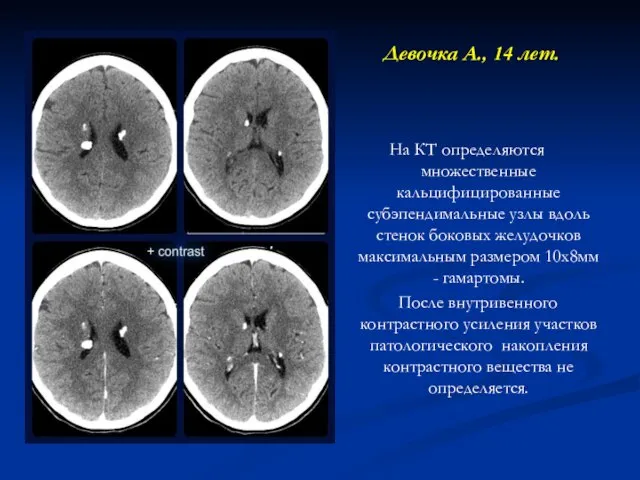 Девочка А., 14 лет. На КТ определяются множественные кальцифицированные субэпендимальные узлы