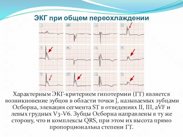 ЭКГ при общем переохлаждении Характерным ЭКГ-критерием гипотермии (ГТ) является возникновение зубцов