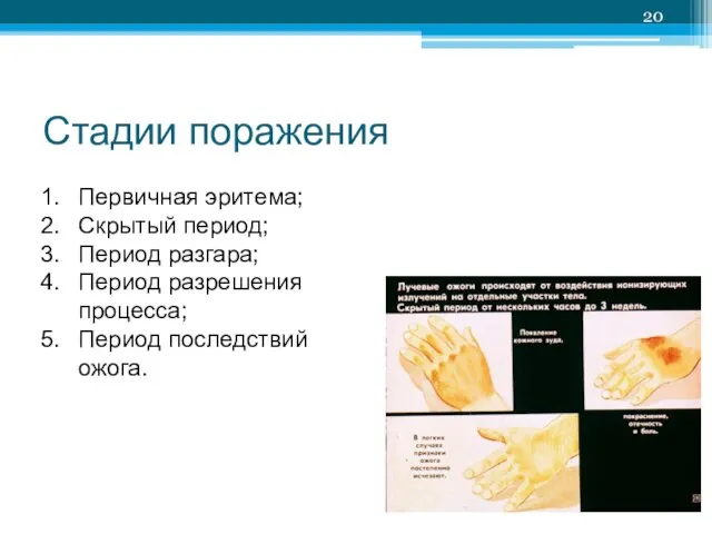 Стадии поражения Первичная эритема; Скрытый период; Период разгара; Период разрешения процесса; Период последствий ожога.