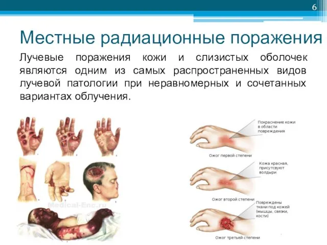 Местные радиационные поражения Лучевые поражения кожи и слизистых оболочек являются одним