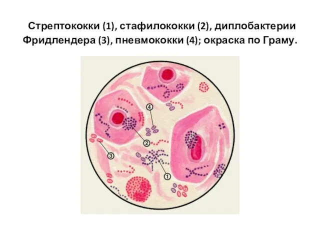 Стрептококки (1), стафилококки (2), диплобактерии Фридлендера (3), пневмококки (4); окраска по Граму.