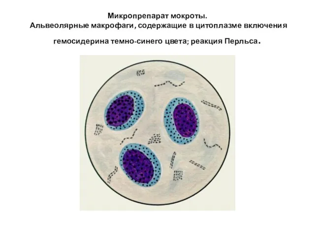 Микропрепарат мокроты. Альвеолярные макрофаги, содержащие в цитоплазме включения гемосидерина темно-синего цвета; реакция Перльса.