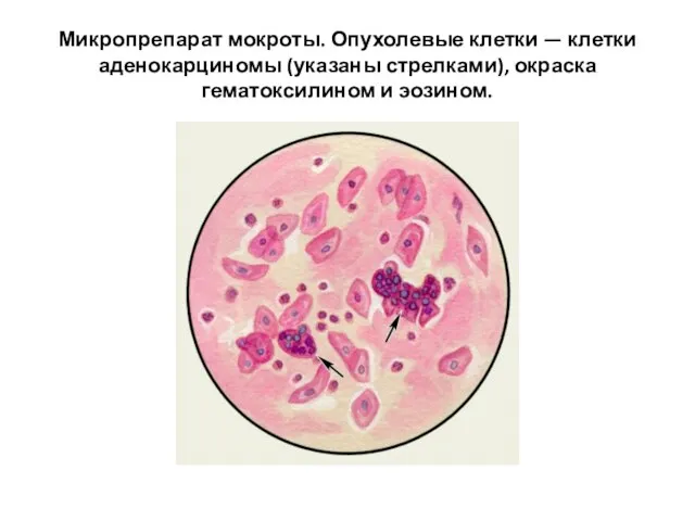 Микропрепарат мокроты. Опухолевые клетки — клетки аденокарциномы (указаны стрелками), окраска гематоксилином и эозином.